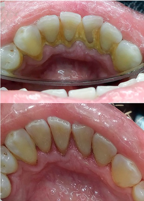 Periodoncia